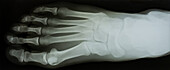 X-Ray, Dorsal View of Left Foot