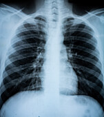 Chest X-ray, Ventral View