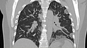 COVID-19 Lungs, CT Scan