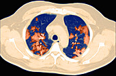 COVID-19 Lungs, CT Scan