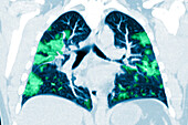 COVID-19 Lungs, CT Scan