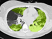 Lungs with Vaping Damage, Follow-up CT