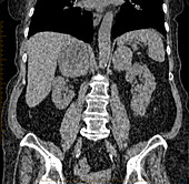 Adrenal Cancer, CT Scan