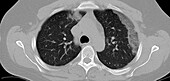 COVID-19 Lungs, CT Scan