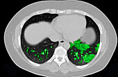 COVID-19 Lungs, CT Scan