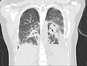 Lungs with Vaping Damage, Follow-up CT