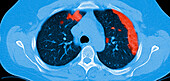 COVID-19 Lungs, CT Scan