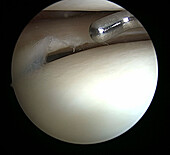 Arthroscopic knee surgery