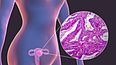 Uterine cancer, illustration and light micrograph
