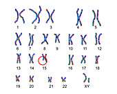 Karyotype of Angelman syndrome, illustration