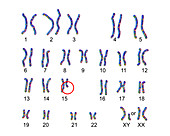 Karyotype of Prader-Willi syndrome, illustration