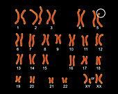 Cri du chat syndrome karyotype, illustration