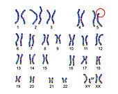 Cri du chat syndrome karyotype, illustration