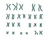 Cri du chat syndrome karyotype, illustration