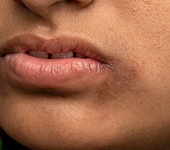 Angular cheilitis