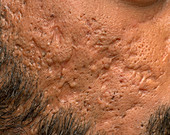Scarring from cystic acne