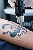 Picosecond laser used for tattoo removal