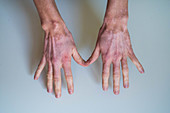 Vitiligo, skin pigment loss