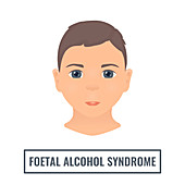 Foetal alcohol syndrome, illustration