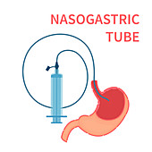 Nasogastric feeding tube, illustration