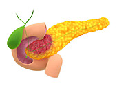 Pancreatic adenocarcinoma, illustration