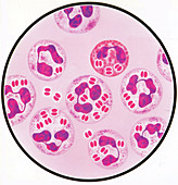 Neisseria gonorrhoea infection, illustration