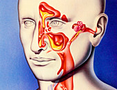 Upper respiratory tract infections, illustration