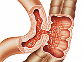 Intestinal fistula, illustration