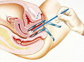 Cervical smear test, illustration