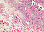 Bladder transitional cell carcinoma, light micrograph