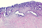 Cervical carcinoma in-situ, light micrograph