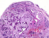 Fibrocystic disease of the breast, light micrograph