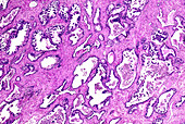 Prostate cancer, light micrograph