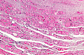 Riedel's thyroiditis, light micrograph