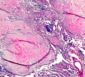 Silicosis, light micrograph