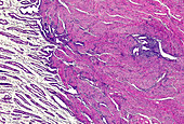 Adenomyosis, light micrograph