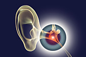 Otitis media ear infection, illustration