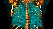 Lungs affected by Covid-19 pneumonia, CT scan