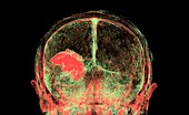 Intraparenchymal haemorrhage, CT scan