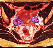 Ovarian cancer, MRI scan