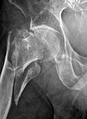 Broken hip, X-ray