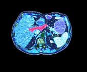 Pancreatic carcinoma, CT scan