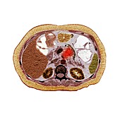 Pancreatic carcinoma, CT scan