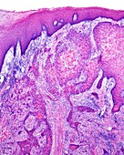 Squamous cell carcinoma of the tongue, light micrograph