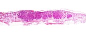 Large basal cell carcinoma, light micrograph