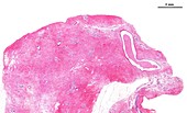Fibrocystic breast change, light micrograph
