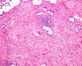 Inflammatory infiltrate around prostate, light micrograph