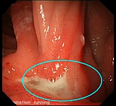 Stomach ulcer, endoscope view