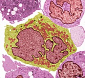 Lymphoma cancer cells, TEM