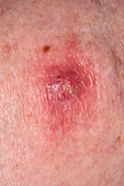 Skin cancer on the leg